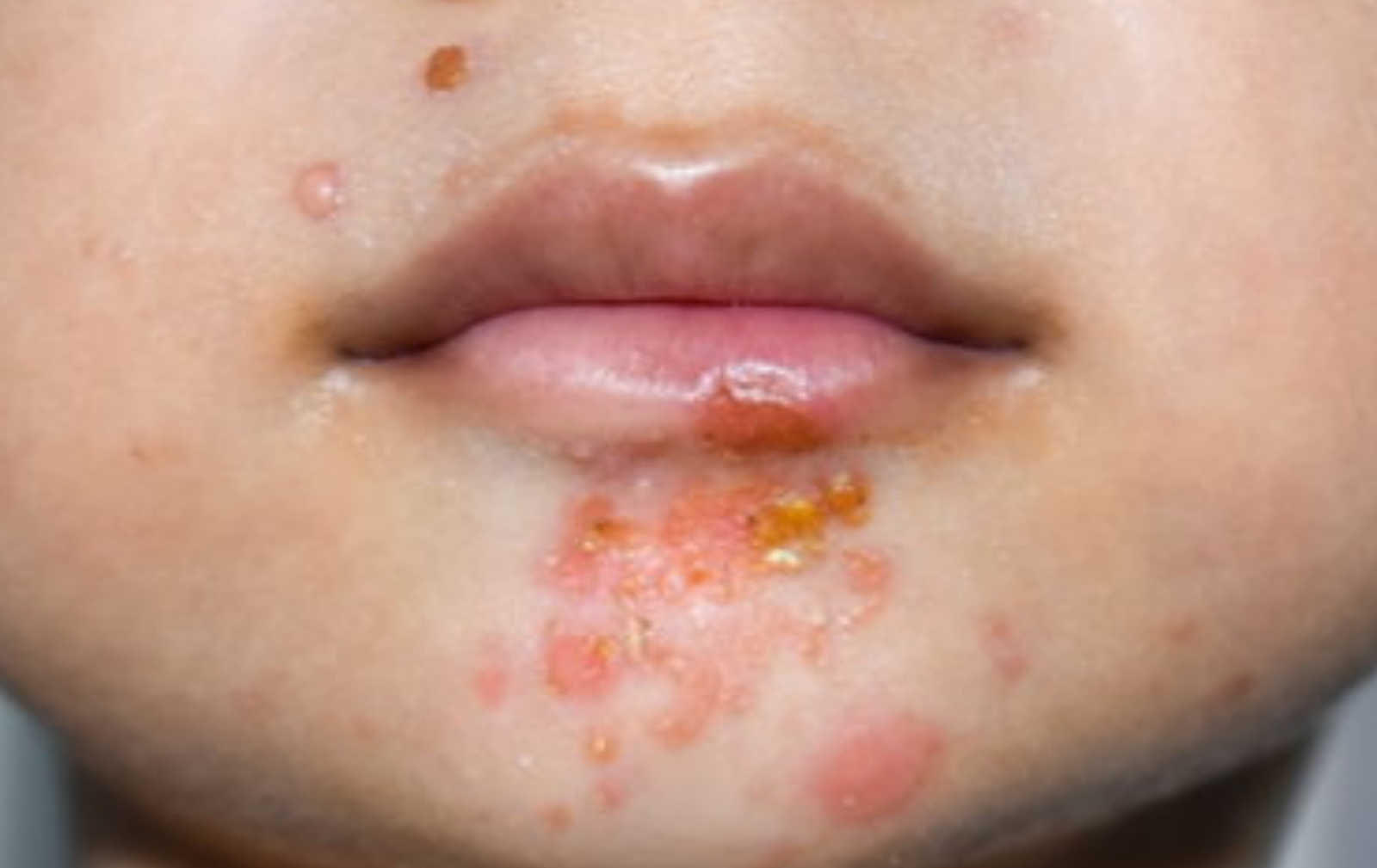 What are School Sores (Impetigo)?