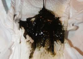 Yes! This is normal MECONIUM. dark green sticky newborn baby poop