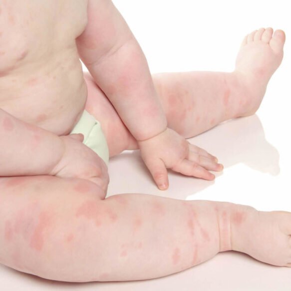 4. rashes 4. rashes